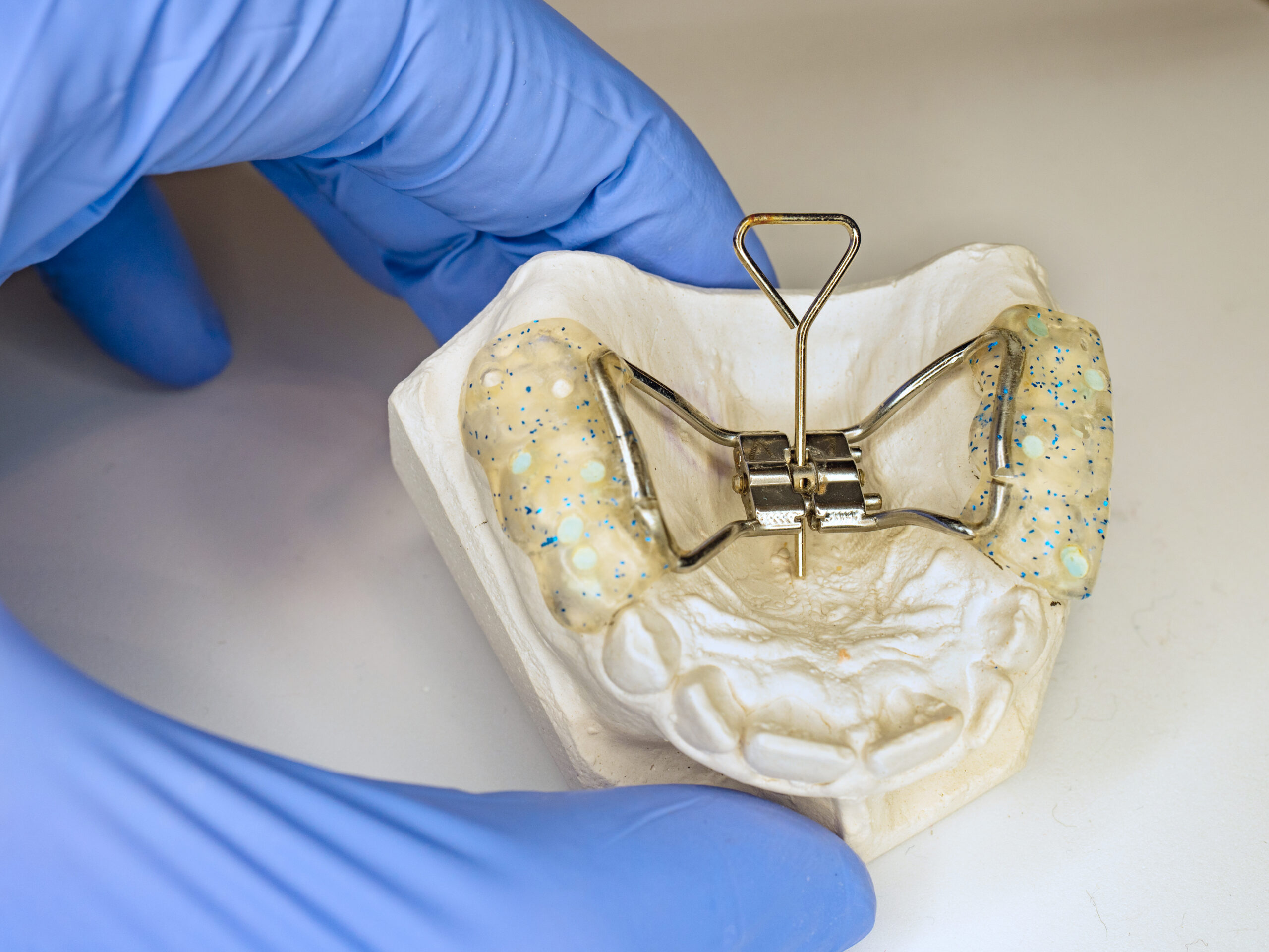 Understanding the Benefits of Palatal Expanders for Growing Smiles