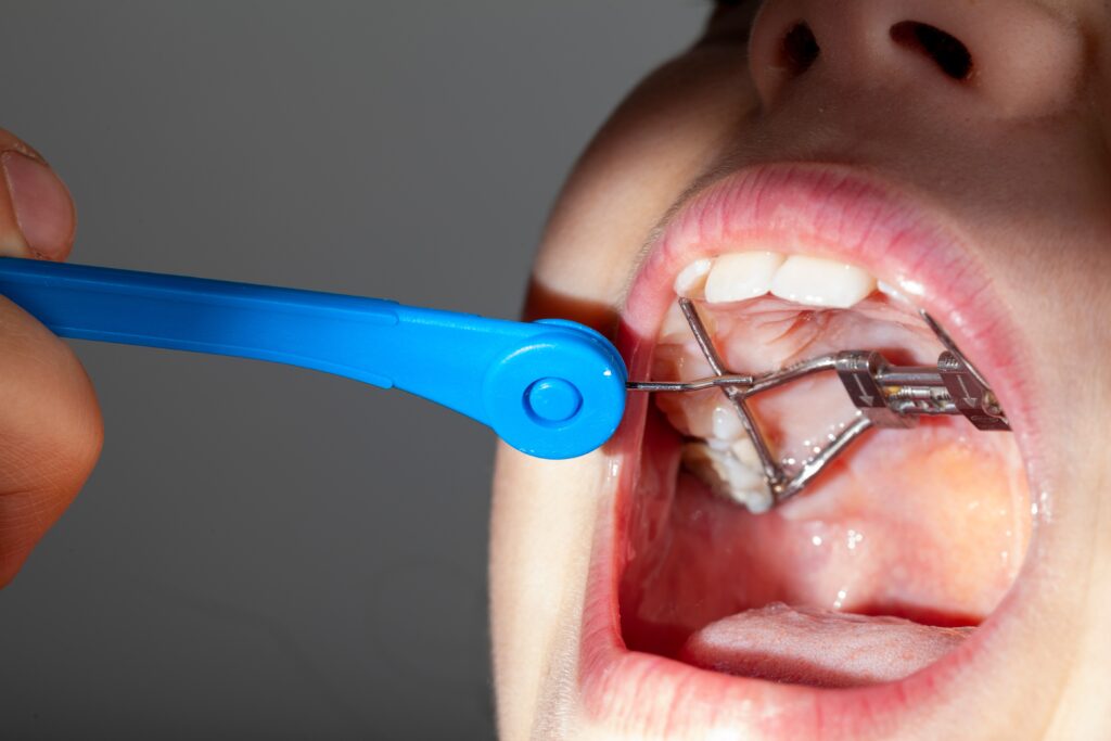 Understanding the Benefits of Palatal Expanders for Growing Smiles
